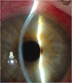 Figure 3: Slit lamp view of the Xen gel stent after implantation. Note the proximal tip of the device inside the anterior chamber that communicates to the subconjunctival space.