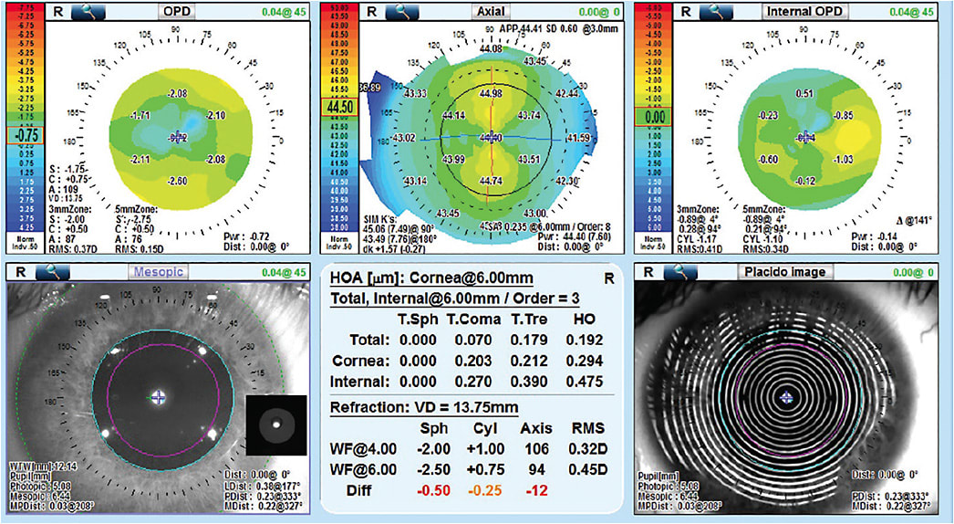 Figure. Cataract evaluation map (OPD III Scan, Marco)IMAGE COURTESY: MARCO