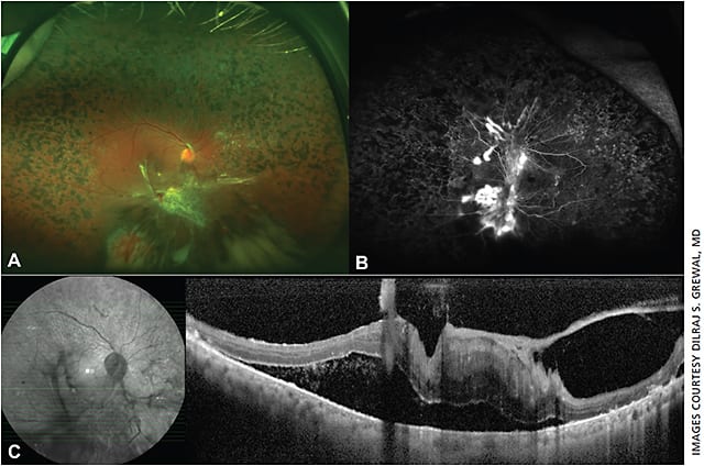 Figure 3. Progression of PDR to a tractional retinal detachment despite panretinal photocoagulation (A), with UWFFA showing neovascularization and staining of peripheral panretinal photocoagulation scars (B). Widefield OCT (C) shows the tractional retinal detachment involving the macula with subretinal fluid and overlying fibrovascular proliferative tissue.