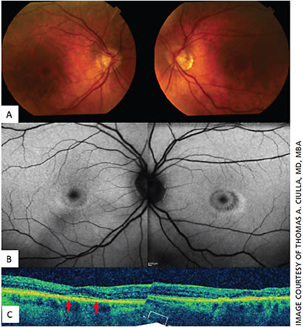 Figure 3. Parafoveal ellipsoid zone loss from hydroxychloroquine retinopathy.