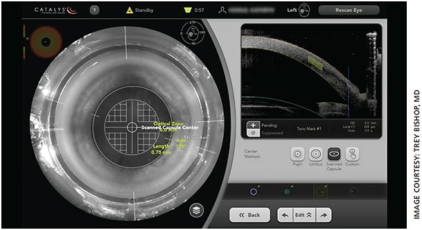 The Catalys system (J&amp;J Vision) places corneal radial intrastromal marks (shown in the treatment overlay and from a side view on the right) along the steep axis of 159º, per the preprogrammed custom settings from the Cassini.