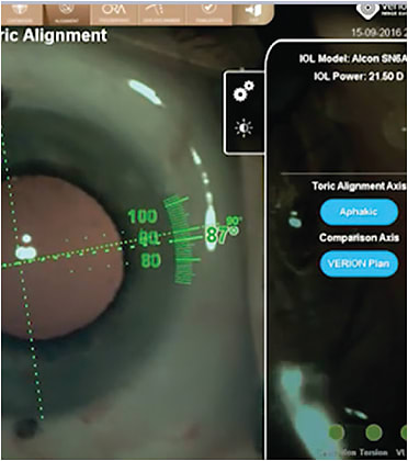 Real-time axis tracking and toric alignment