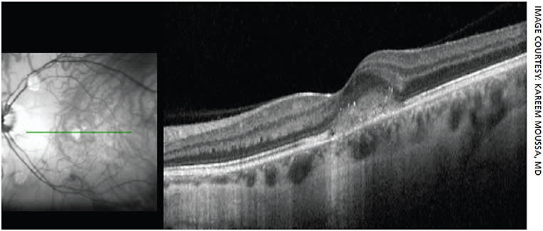 Figure 2. SD-OCT shows disruption of the outer retinal structures and accumulation of abnormal material.