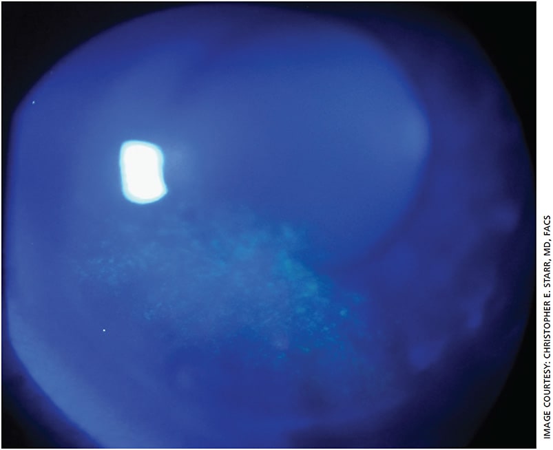Figure 1. Fluorescein dye reveals punctate epithelial erosion, a common cause of dry eye symptoms.