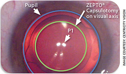 Figure 3. The Zepto capsulotomy (green) is centered on P1 (optical axis) and is displaced slightly nasally when compared to the optical axis, which is centered on the pupil (blue).