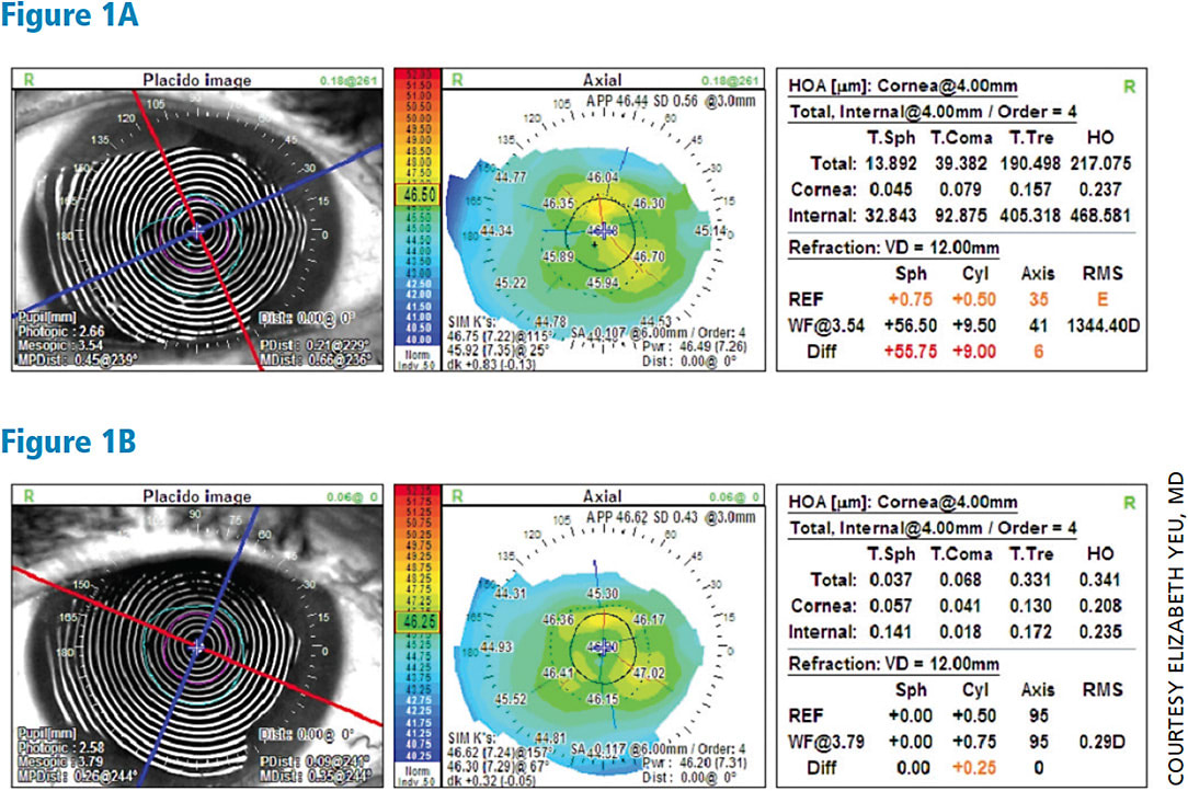 Topography right eye before and after dry eye treatment. Notice placido disc images have sharper and more regular mires in the second image.