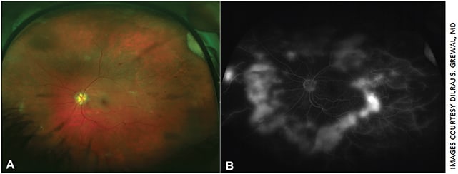 Figure 1. Proliferative diabetic retinopathy: Ultra-widefield fluorescein angiogram (UWFFA) (B) shows the near 360° extent of neovascularization surrounding the posterior pole and the extensive peripheral nonperfusion, which is not apparent on the color fundus photograph (A).