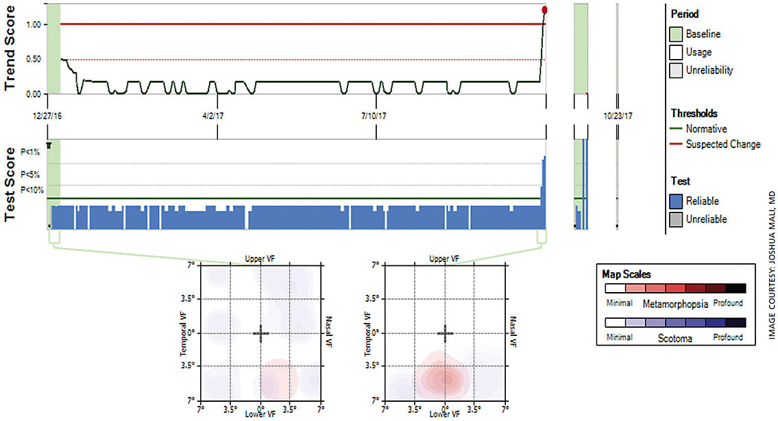 Figure 4. ForeseeHome report. Bottom left shows baseline metamorphopsia map OS. On bottom right, note the significant defect in the metamorphopsia map in the inferior visual field OS as compared to baseline testing. This corresponds to the development of a new CNV lesion as seen on clinical examination.