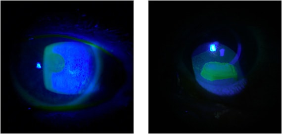 Figure 2. Slit lamp photos and confocal microscopy in Stage 2 NK in trigeminal neuralgia before (left) and after (right) Oxervate treatment.