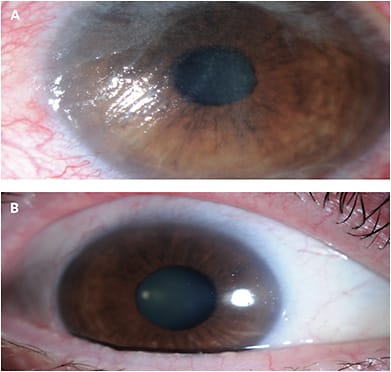 CASE 2. Note this patient’s conjunctival growths (A), and the improvement of epithelial cell regeneration (B).