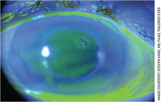 FIGURE 1. Slit lamp color photo of the cornea taken under cobalt blue light with fluorescein stain showing elevated negative staining changes from anterior basement membrane dystrophy.