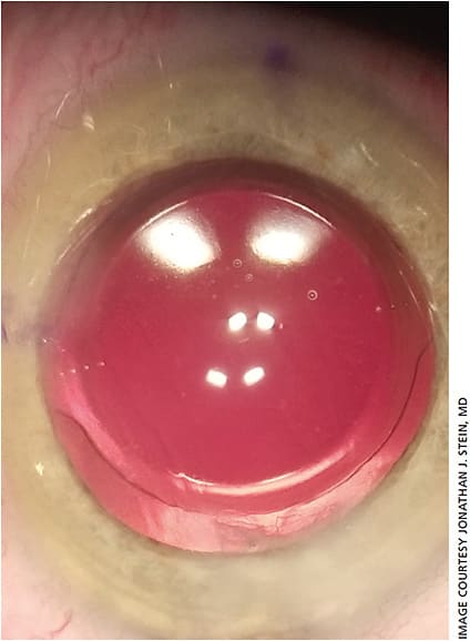 Figure 1. Toric IOL immediately after implantation.