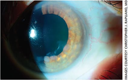 Figure 2. Numerous creamy white elevated lesions of Salzmann’s nodular degeneration can be seen inferiorly.