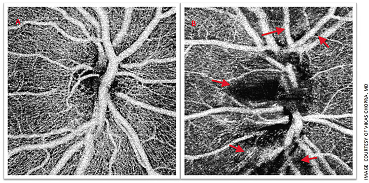 Figure 1: OCTA of the optic disc from a normal eye (A) and from an eye with mild glaucoma (B), which reveals reduced retinal vascular densities (vascular “drop-out” shown by greater darker regions) in the glaucomatous eye.