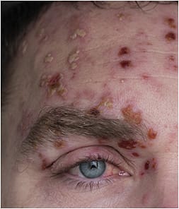 Man with herpes zoster (shingles) on the face, close up.
