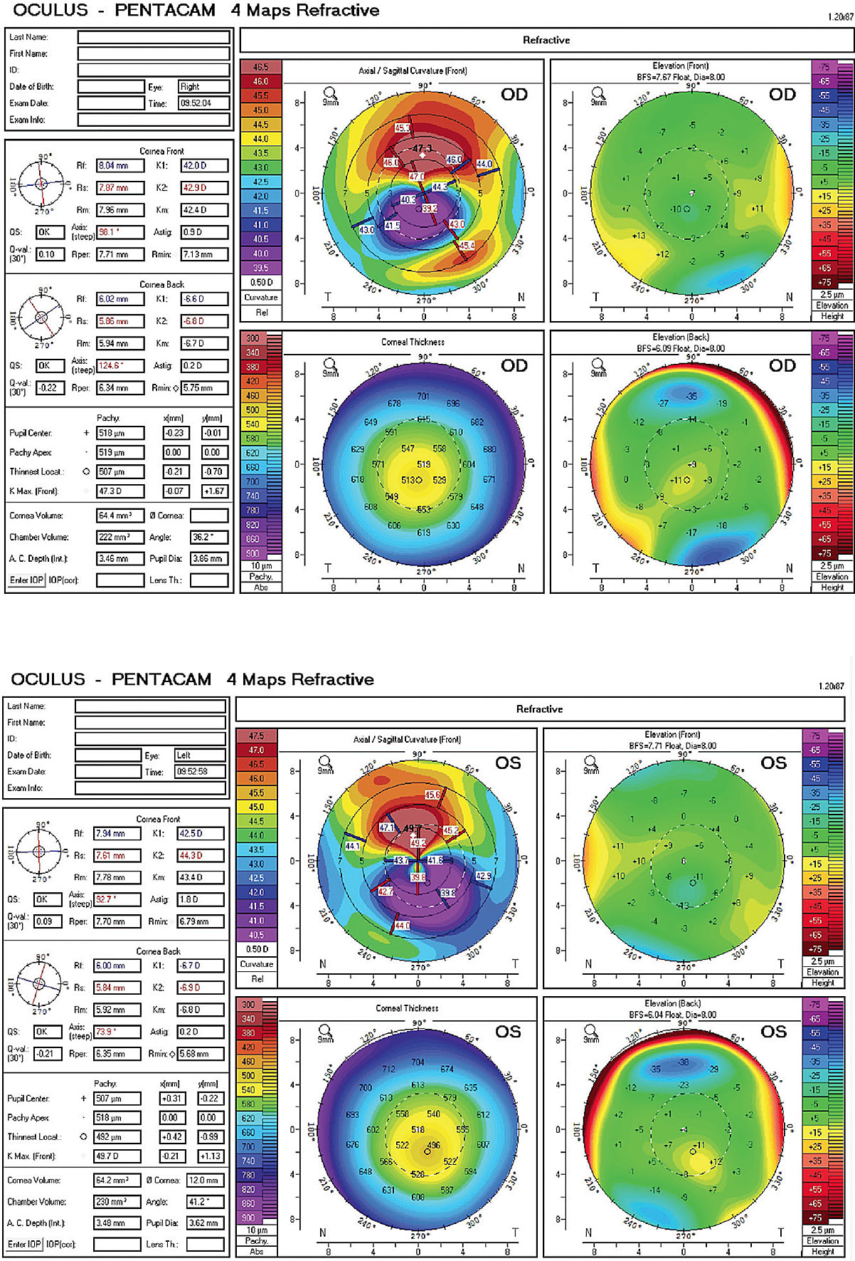 Figure 1. Entering topographies of patient referred for corneal cross-linking evaluation.