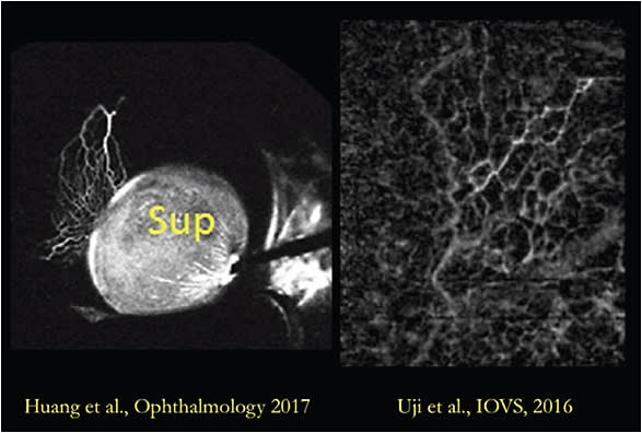Figure 9. A side-by-side comparison of invasive outflow angiography (left) and non-invasive “virtual casting” (right) suggests that a similar level of structure detail may be obtained by either technique.3,22