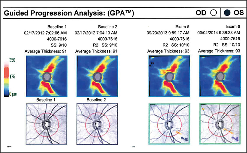 Figure 1. Slit-lamp examination with OCT showed a robust nerve fiber layer.