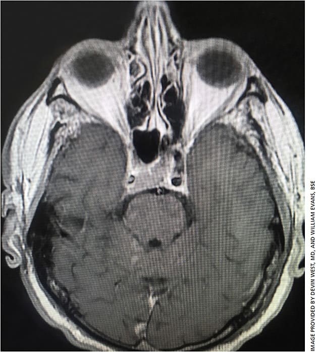 Figure 2. Traverse section of invasive cavernous sinus multiple myeloma.