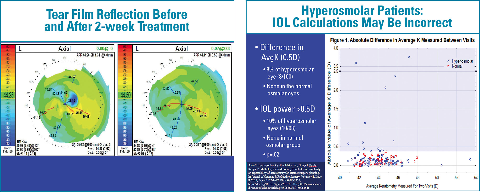 Figure 1. This patient, who presented for a cataract surgery consultation, had an unhealthy tear film and irregular ocular surface (left). Two weeks of treatment optimized the ocular surface (right), enabling accurate keratometry readings.