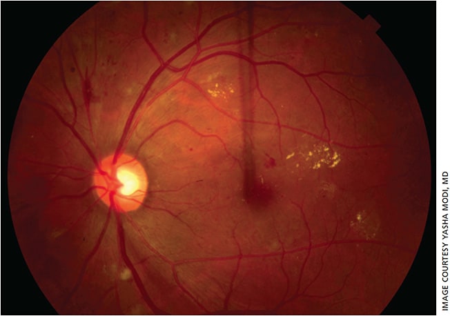 Figure 1. Clinical fundus photo of the left eye demonstrating diabetic macular edema.