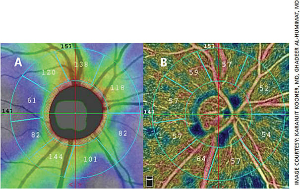 Figure 1. A 66-year-old East Indian healthy female with no history of glaucoma. A. Average peripapillary nerve fiber layer thickness = 105 µ.
B. Circumpapillary vessel density 56%.