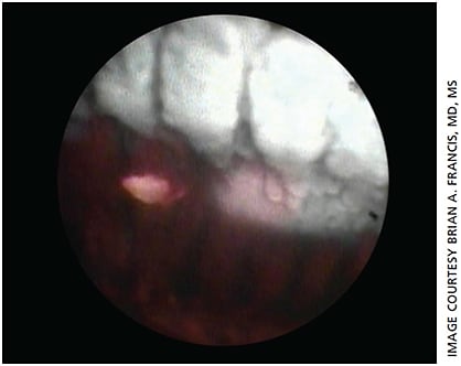 Figure 2. Endoscopic surgical photograph of ECP plus procedure. The treated ciliary processes are visible in the upper part of the image with the treated pars plana in the middle third of the image. The red spot is the aiming beam, and the untreated pars plana is below.