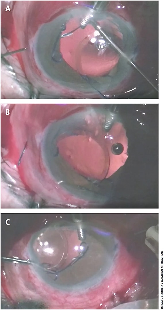 Figure 1. Demonstration of the Yamane technique for scleral fixation of a posterior chamber intraocular lens (IOL), part 1. The leading haptic of a three-piece IOL (EC-3 PAL; Aaren Scientific, Inc., Ontario, CA) is guided into a thin-wall 30-gauge needle (TSK Laboratory, Tochigi-Ken, Japan) (A) and subsequently externalized through a scleral tunnel (B). A silicone clamp from a set of iris retractors is placed to prevent slippage of the leading haptic. The trailing haptic is similarly fed into a second thin-wall 30-gauge needle (C).