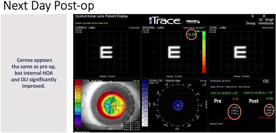 Figure 14: iTrace scan of the patient post LFT. The DLI increased to 10, the internal HOA improved from 0.195 to 0.087 and there were no changes in corneal aberrations, topography or autorefraction.