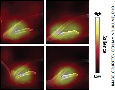 FIGURE 2. Saliency map showing pixels important to the DL algorithm’s decision-making in descending order of importance: white, yellow, red, black.