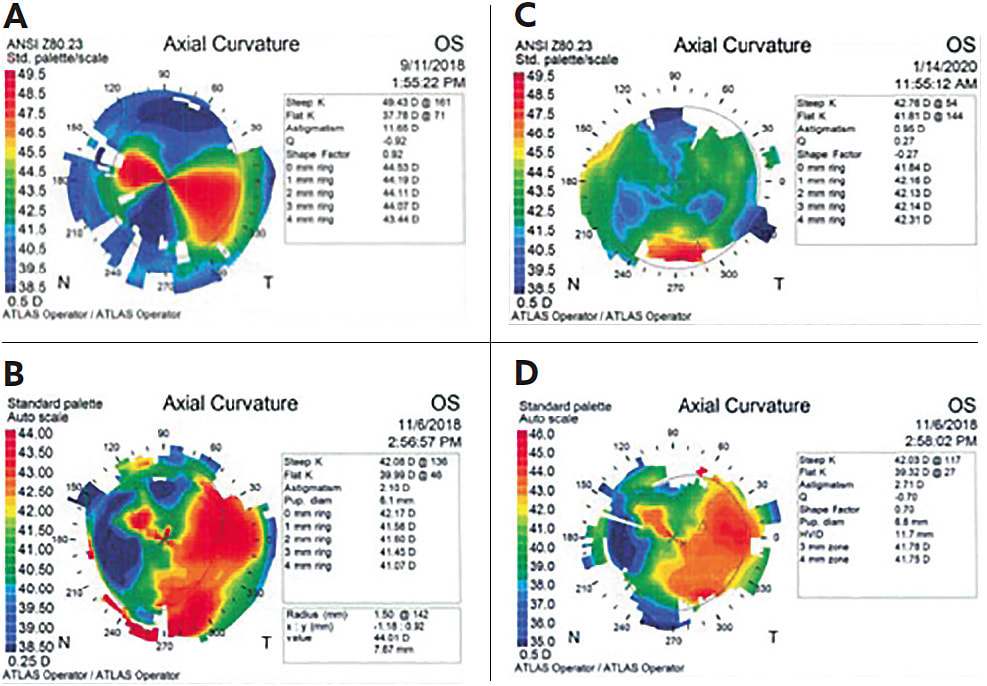 FIGURE 1: Corneal topographies demonstrating suture removal of the same patient. Fig 1A: Postop month 1 topography prior to suture removal. Fig 1B: Postop month 3 topography after removal of a suture in the 11 o’clock meridian. Fig 1C: Postop topography following removal of all sutures demonstrating minimal corneal astigmatism. Fig 1D: Same day postop month 3 topography following suture removal in the 4 o’clock meridian. IMAGE COURTESY SOROOSH BEHSHAD, MD, MPH