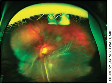 Figure 2. Macula-off rhegmatogenous retinal detachment in a 52-year-old man with decreased vision for five days prior to presentation.