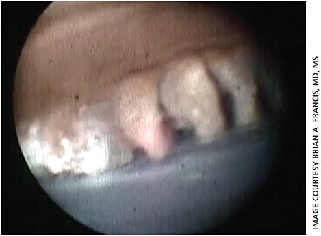 Figure 1. Intraoperative endoscopic image of a case of plateau iris shows the treated and untreated ciliary processes. The treated processes on the left are whitened and decreased in size compared to the untreated processes on the right.