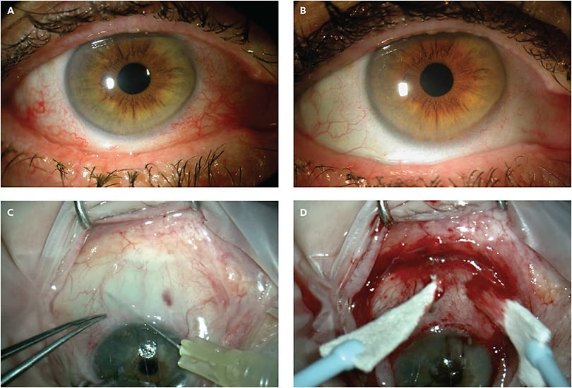 FIGURE 2. Before and after sutureless ocular surface reconstruction with cryopreserved amniotic membrane. Preoperatively, significant conjunctival and corresponding lid margin inflammation are noted without obvious conjunctival redundancy (A). Prior to the surgical procedure, significant Tenon’s degeneration, conjunctival laxity, orbital fat prolapse, and obliteration of the inferior fornix are noted (B). A significant reduction in ocular surface and lid margin inflammation are noted postoperatively (C). Intraoperatively, there is immediate restoration of fornix tear reservoir depth and definition (D).