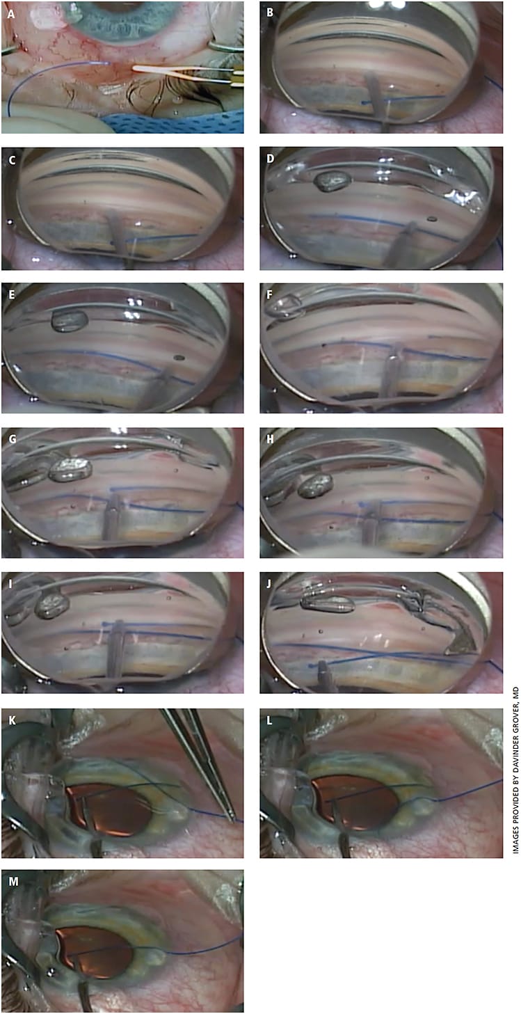 Figure 1. Intra-operative photos demonstrating the key portions of the GATT procedure using a 5-0 Prolene suture. A) The Prolene suture is cut at a point with natural curvature. An Ophth-temp cautery is used to make a small, blunt and rounded tip. Caution should be used to avoid making the blunted tip too large. B) A goniotomy is created with a 25-gauge MVR blade. One can appreciate the size of the blunted tip with the Prolene in the anterior chamber. C) Using the MVR blade to gently depress the posterior lip of the trabecular tissue, the white strip at the back wall of Schlemm’s canal can be observed. D) The Prolene suture has been used to cannulate Schlemm’s canal and has passed 2 clock hours into the canal. E) The suture has been passed roughly 180°. At 270°, one can expect to feel an increase in resistance to passing the suture. A four-mirror gonio prism can be used to locate the tip of the suture, if there is concern about the location within the canal. F) The suture has passed nearly 360°. One can appreciate the distal tip of the suture coming into view of the gonio prism. G) The distal tip of the suture has passed 360° and is in the area of the initial goniotomy. H) The distal tip is carefully retrieved, with caution used not to grab any other angle structures while purchasing the suture tip. I) Once the distal tip is safely retrieved, one can now focus on creating the 360° trabeculotomy. J) One can begin to externalize the distal tip and initiate the trabeculotomy. K) An external view demonstrating traction being placed on both the proximal and distal ends of the suture. A 90° trabeculotomy has been created so far. L) A near total trabeculotomy has been created. M) The suture is entirely out of the canal and thus a 360° trabeculotomy has been created.