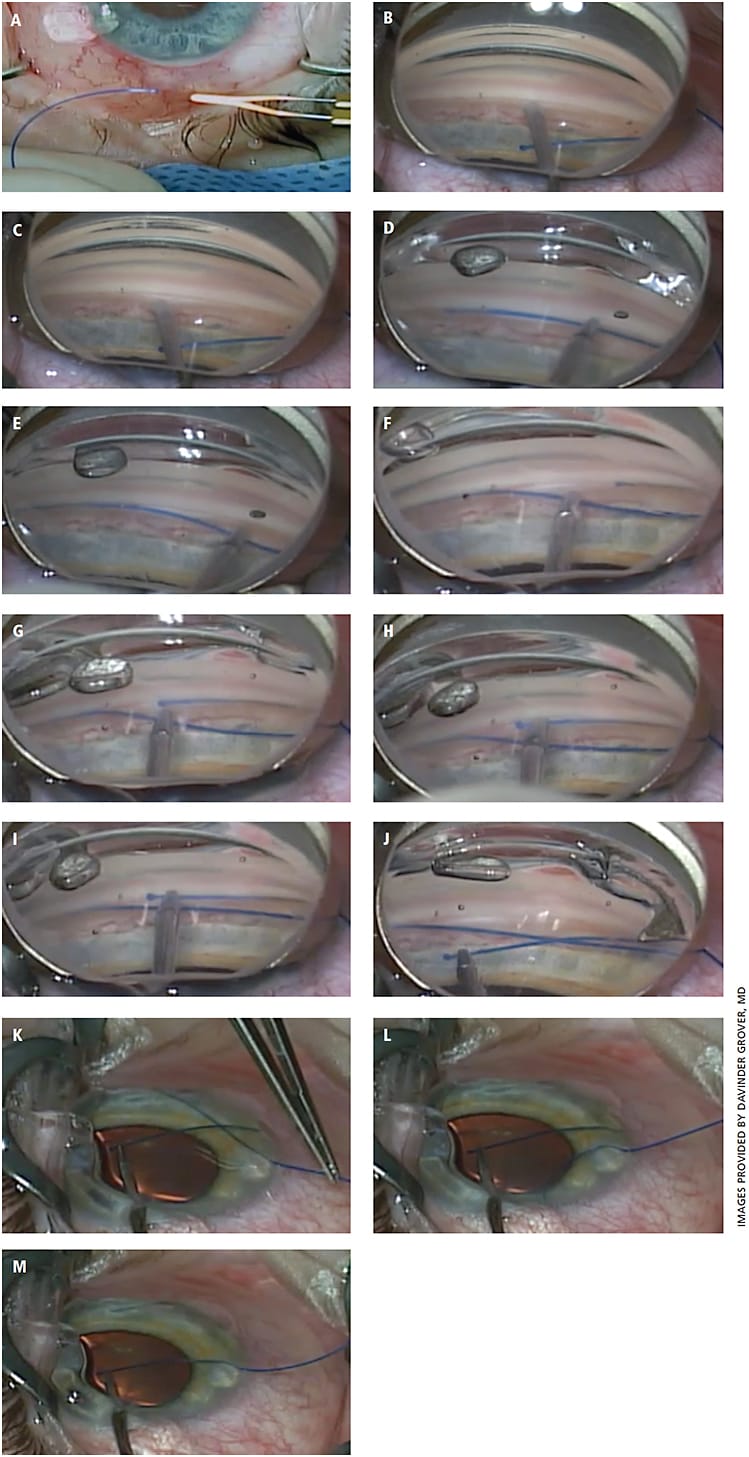 Figure 1. Intra-operative photos  demonstrating the key portions of the GATT procedure using a 5-0 Prolene suture. A) The Prolene suture is cut at a point with natural curvature. An Ophth-temp cautery is used to make a small, blunt and rounded tip. Caution should be used to avoid making the blunted tip too large. B) A goniotomy is created with a 25-gauge MVR blade. One can appreciate the size of the blunted tip with the Prolene in the anterior chamber. C) Using the MVR blade to gently depress the posterior lip of the trabecular tissue, the white strip at the back wall of Schlemm’s canal can be observed. D) The Prolene suture has been used to cannulate Schlemm’s canal and has passed 2 clock hours into the canal. E) The suture has been passed roughly 180°. At 270°, one can expect to feel an increase in resistance to passing the suture. A four-mirror gonio prism can be used to locate the tip of the suture, if there is concern about the location within the canal. F) The suture has passed nearly 360°. One can appreciate the distal tip of the suture coming into view of the gonio prism. G) The distal tip of the suture has passed 360° and is in the area of the initial goniotomy. H) The distal tip is carefully retrieved, with caution used not to grab any other angle structures while purchasing the suture tip. I) Once the distal tip is safely retrieved, one can now focus on creating the 360° trabeculotomy. J) One can begin to externalize the distal tip and initiate the trabeculotomy. K) An external view demonstrating traction being placed on both the proximal and distal ends of the suture. A 90° trabeculotomy has been created so far. L) A near total trabeculotomy has been created. M) The suture is entirely out of the canal and thus a 360° trabeculotomy has been created.