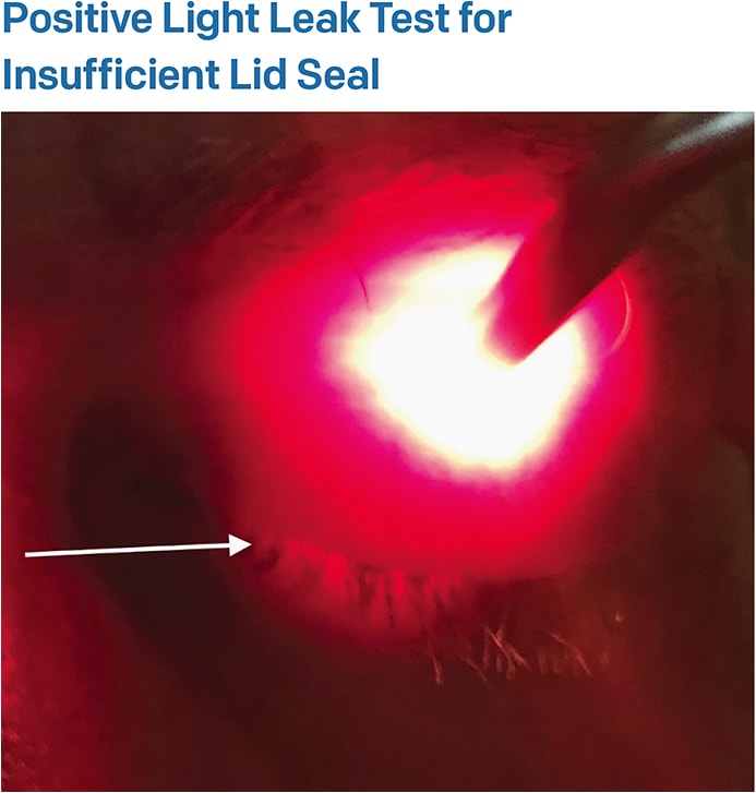 Figure 1. Light  escaping through  the interpalpebral fissure (white arrow) suggests an insufficient eyelid seal.