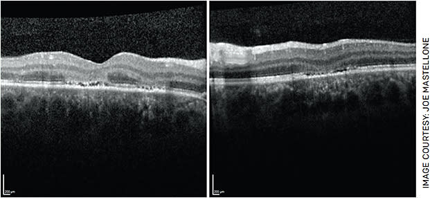FIGURE 2. Optical coherence tomography (OCT) of the macula OU demonstrating focal areas of hyperreflectivity involving the outer nuclear layer with loss of the underlying ellipsoid zone in the right eye (left image). There is overlying depression of the inner retinal layers in the left eye (right image).