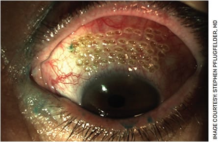 FIGURE 5. Superior bulbar conjunctival cautery