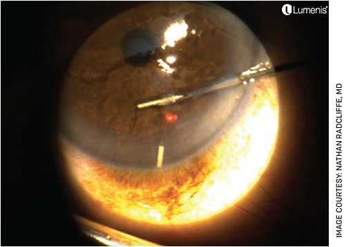 FIGURE. Durysta (Allergan) injection performed at a YAG/SLT laser with video capability (Lumenis Duet). An eyelid speculum was placed, and the implant is seen sinking towards the inferior angle after injection.