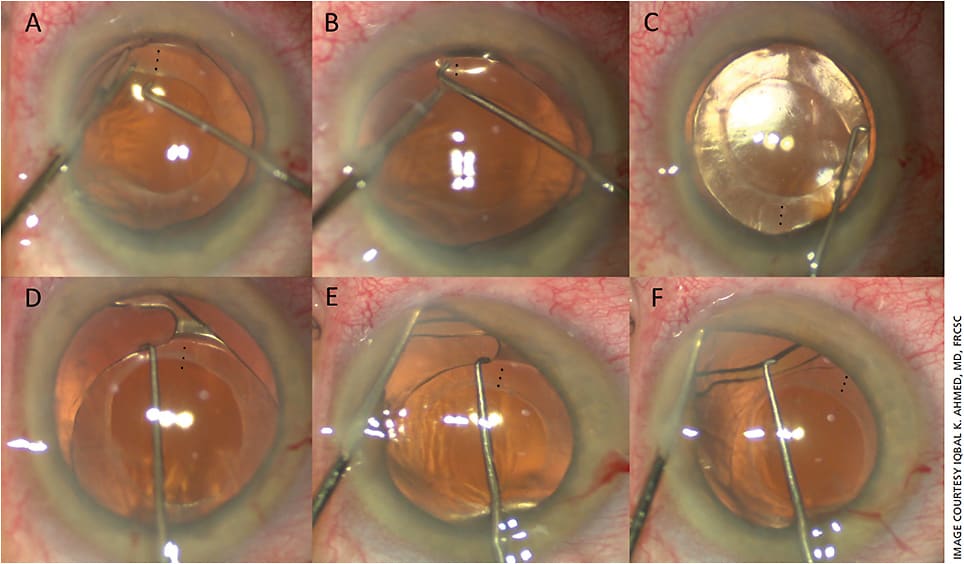 Figure 2. Intraoperative realignment of the 23.0 D Acrysof IQ Toric SN6AT IOL. Micrograspers (Microsurgical Technology) were used to stabilize the anterior leaflet of the capsular bag while a Sinskey lens hook (Katena) was used to dissect the IOL from the capsular bag (A-D). A Kuglen hook (Katena) was used to displace the iris while a Sinskey hook freed the IOL haptics (E/F).