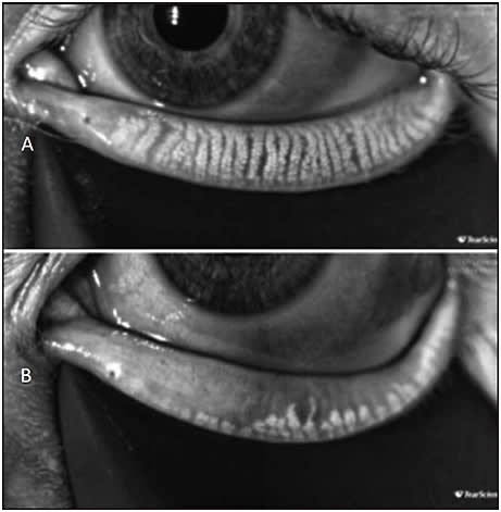 Figure 2. Using LipiView imaging, our technician can explain the differences between normal meibomian glands (A) and dysfunctional glands (B).