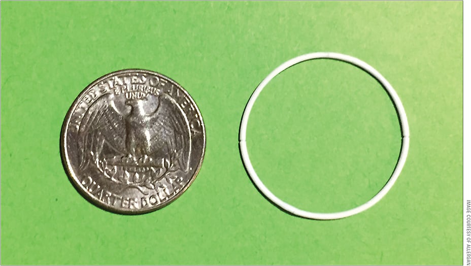 Figure 1. The Bimatoprost Ring, still in development at Allergan, is composed of a silicone matrix over an inner polypropylene ring that fits in the fornices of the eye and delivers bimatoprost over a 4-month period.