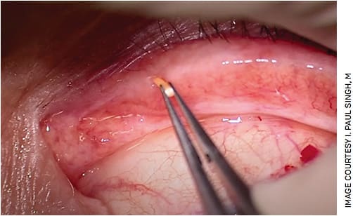 FIGURE 2. An eyecare practitioner inserts resorbable DEXTENZA (Ocular Therapeutix) into a patient’s tear duct.