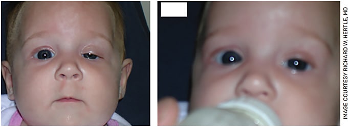 Figure 3. “Marcus-Gunn Jaw-Wink” in patient’s left eye.