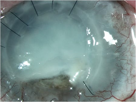 Figure 2. Previously undiagnosed lupus. Over a period of months, while bilateral corneal perforation was occurring, this patient was diagnosed and treated for uncontrolled lupus. Whenever a bilateral process exists, systemic etiologies may underlie the ocular problem.