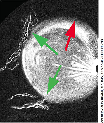 Figure 2. Aqueous angiography was performed in the left eye of a 60-year-old Asian female during cataract surgery. 0.4% indocyanine green (ICG) was introduced into the anterior chamber. Angiographic images were taken using a Spectralis OCT+HRA (Heidelberg Engineering). Centrally, the anterior chamber is filled with ICG. Posterior to the limbus, the green arrows show areas of distal angiographic outflow. The red arrow shows a region without.