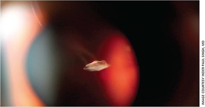 Figure 5. The view achieved for a Weiss using the reflex tower providing true coaxial Illumination. With the slit lamp 15° oblique, we can maximize the view of the opacity and still provide spatial context of where the retina is located. Here, the floater is in focus but retina is not seen, indicating safe distance to fire.