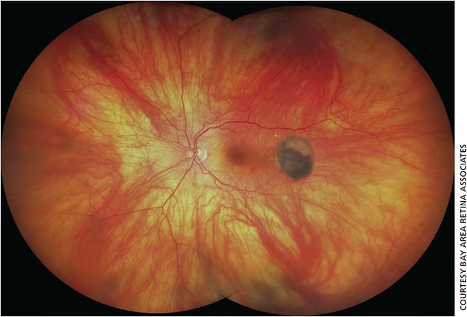 Figure 1. Ultra-widefield true color image of a hemorrhagic PED (PEHCR) temporal to the fovea; image taken on the Zeiss Clarus 500.