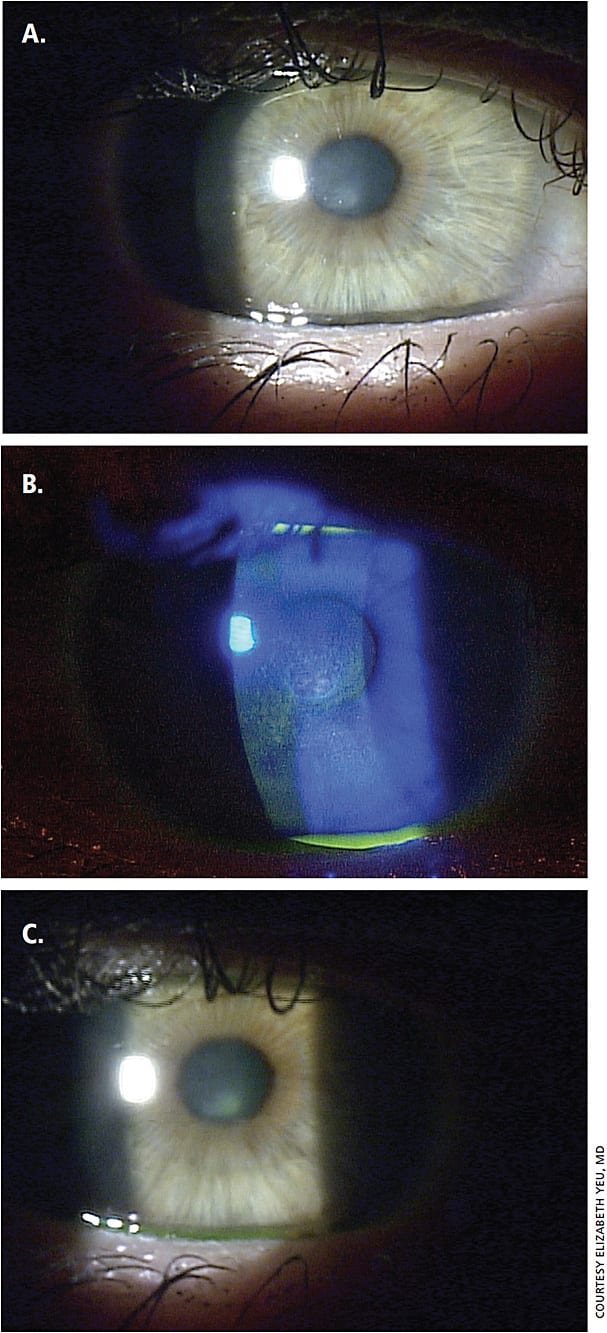 Figure 1. Stage 1 NK. HSV stromal keratitis in a 28-year-old patient who is stable on topical low dose steroid once daily and oral valacyclovir twice daily.